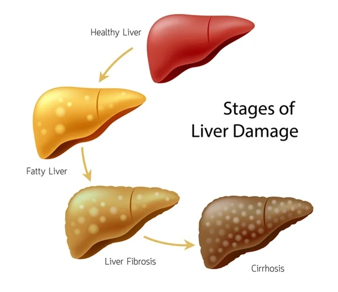 end stage liver disease process